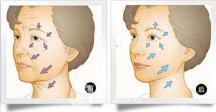 热玛吉紧肤除皱果图,热玛吉紧肤除皱果好吗?