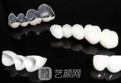 烤瓷牙好还是植牙好