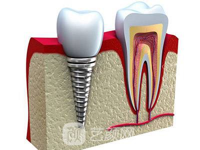 烤瓷牙好还是植牙好