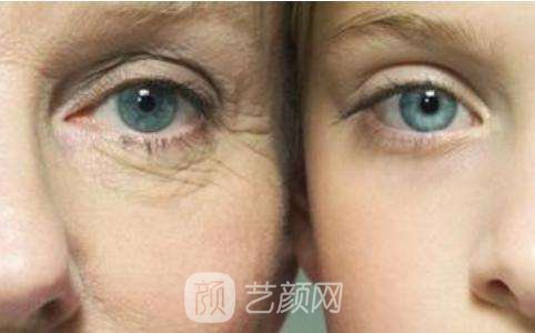 注射去鱼尾纹果图,注射去鱼尾纹果如何?