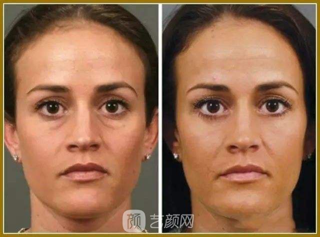 【上下眼睑提升手术果好吗？上下眼睑提升手术果图~】