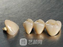 烤瓷牙价格多少