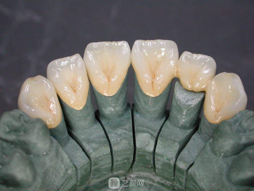 烤瓷牙价格多少