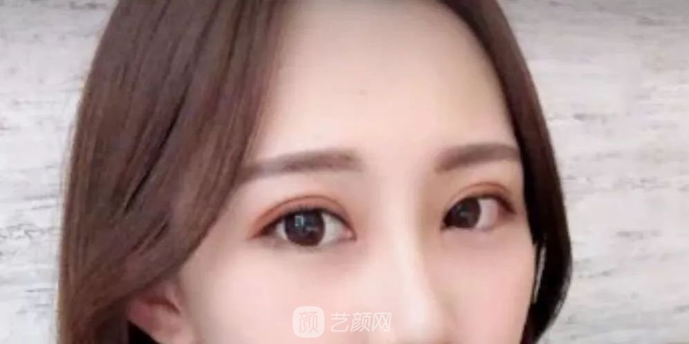 眼部手术一个月恢复日记，片分享~