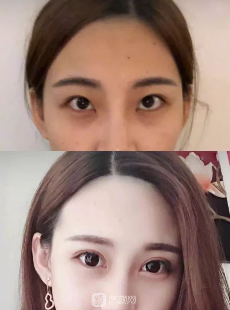 眼部手术一个月恢复日记，片分享~