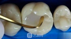 在成都做牙齿填充价格贵不贵？