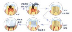 牙齿填充材料种类，品牌，价格