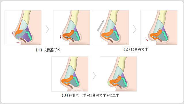 朝天鼻矫正大概要多少钱?