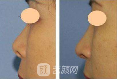 朝天鼻矫正大概要多少钱?