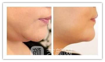 吸脂去双下巴要多少钱?