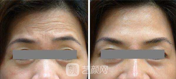 微晶瓷去抬头纹多少钱?