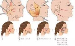 成都热玛吉拉皮除皱多少钱?