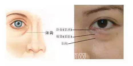 玻尿酸丰泪沟果图，玻尿酸丰泪沟果好吗?