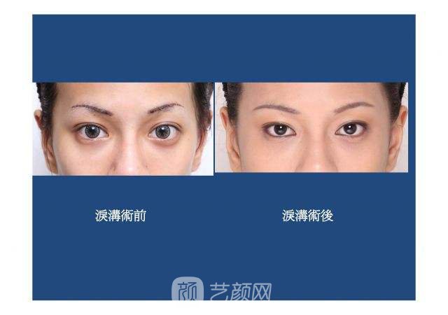 玻尿酸丰泪沟果图，玻尿酸丰泪沟果好吗?