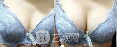 张书明医生隆胸案例