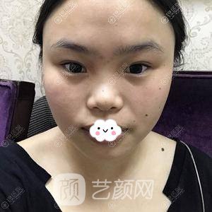 成都美容整形医院冯春雨硅胶隆鼻+假体垫下巴案例