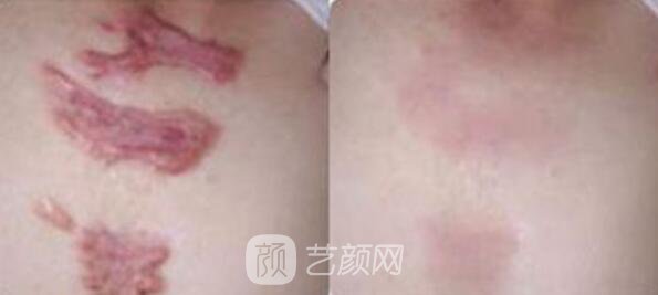烫伤疤痕修复多少钱？