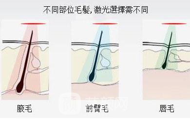 激光脱毛没问题吗?