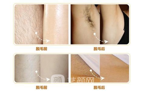 激光脱毛没问题吗?