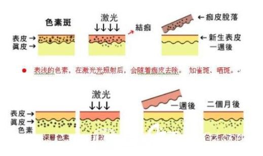 光子嫩肤有副作用吗?光子嫩肤的副作用有哪些?
