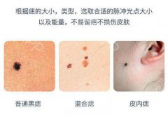 深圳激光去痣的价格是多少?