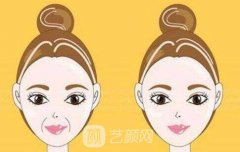 玻尿酸鼻唇沟除皱费用贵不贵?