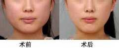 去颊脂垫2019全新价格