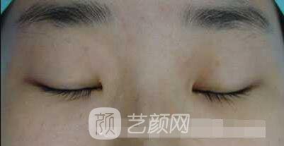 张娇娇医生做的小切口双眼皮手术案例