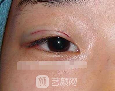 张娇娇医生做的小切口双眼皮手术案例