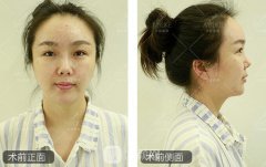 的鼻部手术案例，隆鼻后的美丽人生