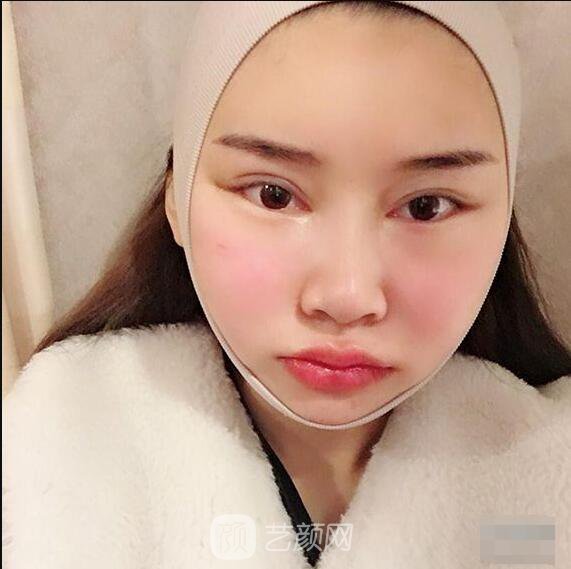 颧骨内推真实案例，小脸网红模板脸型