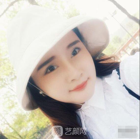 颧骨内推真实案例，小脸网红模板脸型