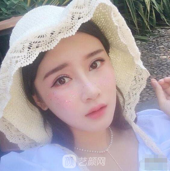 颧骨内推真实案例，小脸网红模板脸型