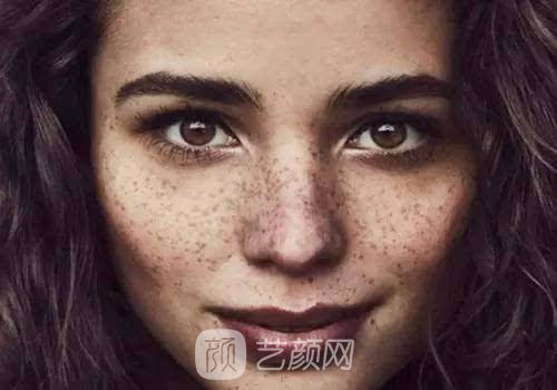 如何祛黄褐斑比较好?