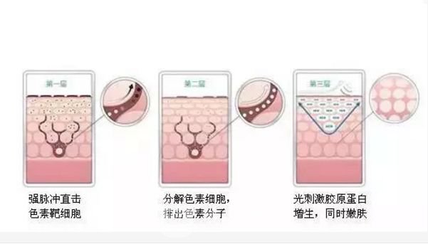 如何祛黄褐斑比较好?