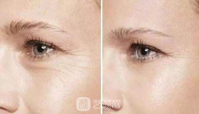 去眼角皱纹的方法有哪些?