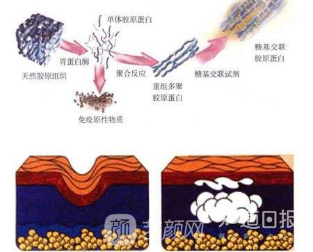 注射胶原蛋白隆鼻能管多久?