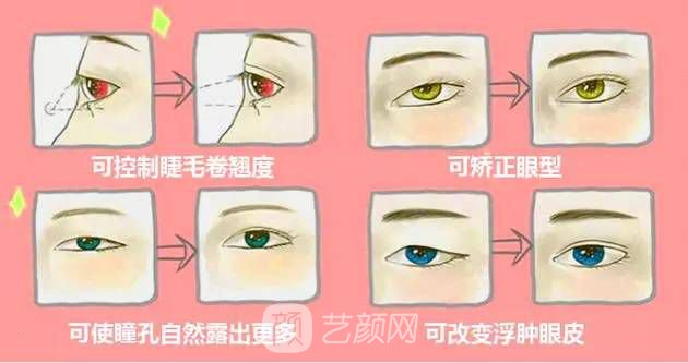 埋线双眼皮多久恢复自然?