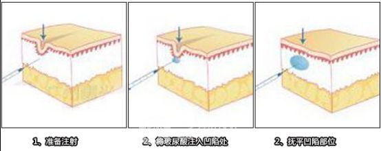 玻尿酸丰泪沟果好吗?