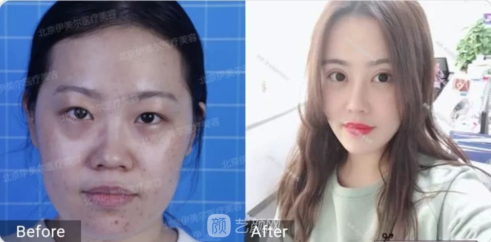 伊美尔幸福李辉灵动面部年轻化术后两个月恢复日记~