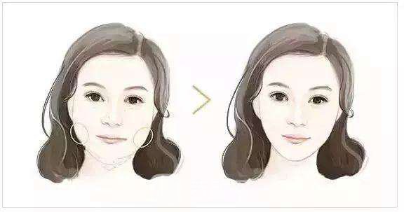 面部填充物取出要多少钱