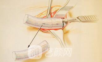 自体肋骨隆鼻有后遗症吗