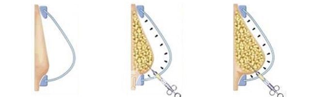 注射隆胸失败修复多少钱?