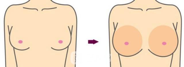 注射隆胸失败修复多少钱?