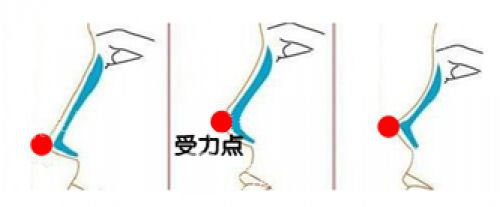 朝天鼻如何修复比较好?