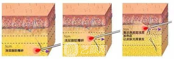 光纤溶脂多少钱?