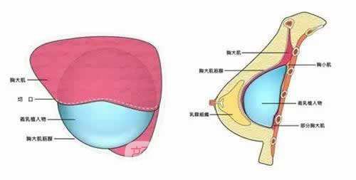 杭州韩式隆胸整形费用?