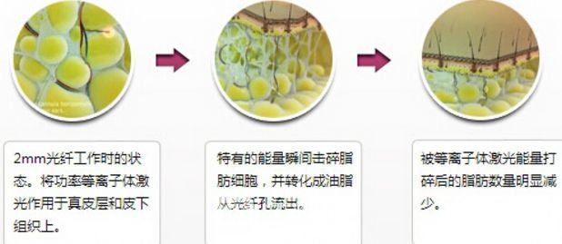 光纤溶脂消肿要多久?