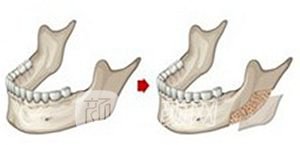 磨下颌角有风险吗?