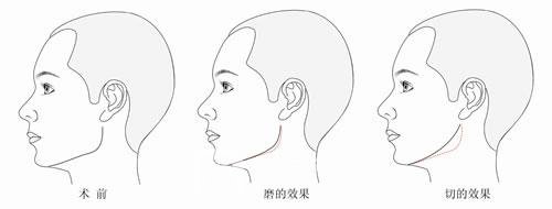 磨下颌角有风险吗?